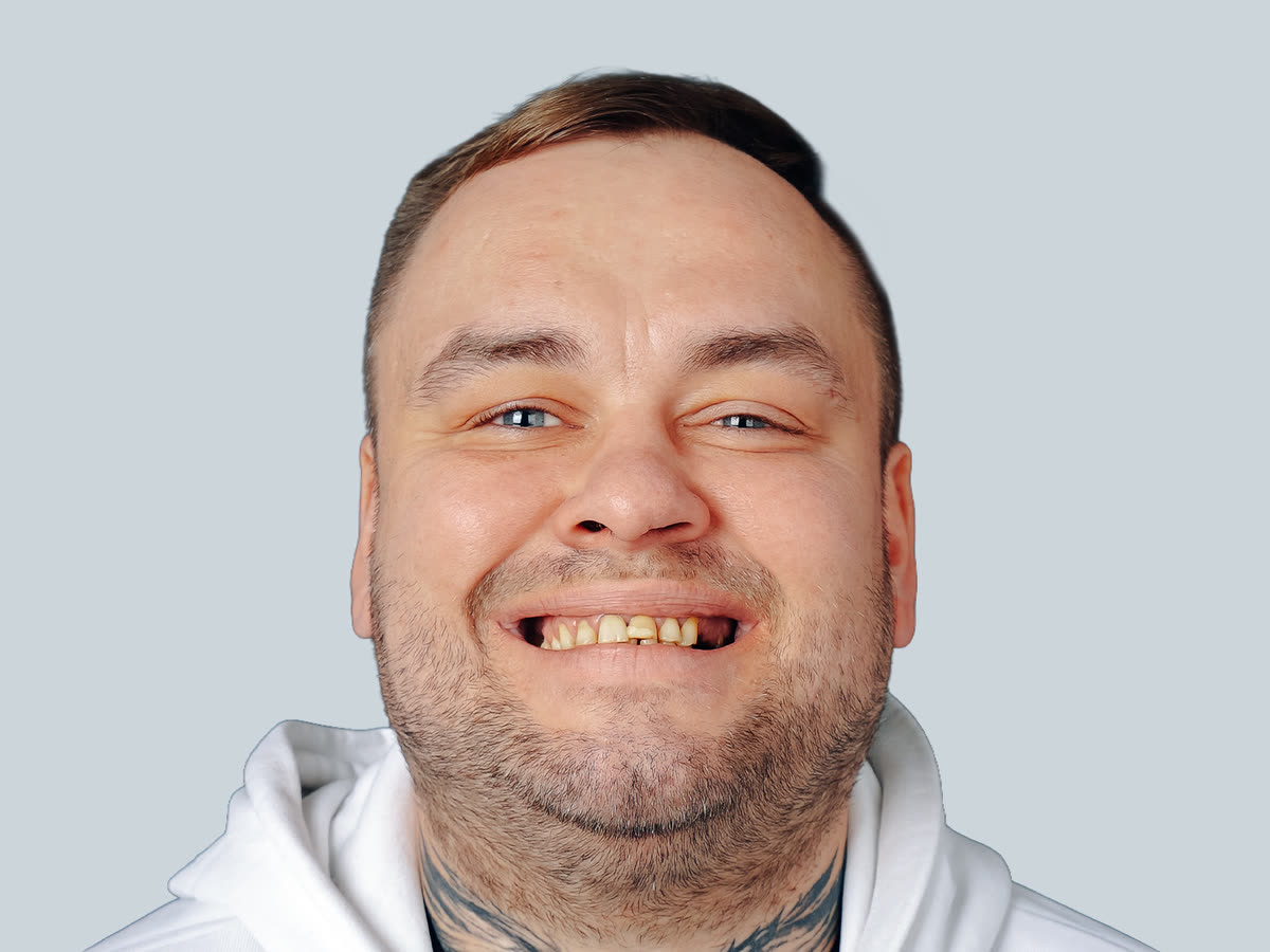 Smile before E-max veneers · Smile makeover — patient Kamil from Poland